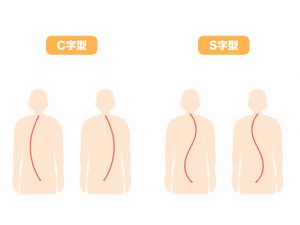 脊椎側弯症 種類 水戸市の鍼灸整骨院 ふじ鍼灸整骨院 茨城県庁から車で6分の整体 鍼灸